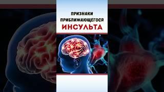 Признаки приближающегося инсульта