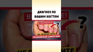 Какие болезни можно диагностировать по ногтям #shorts